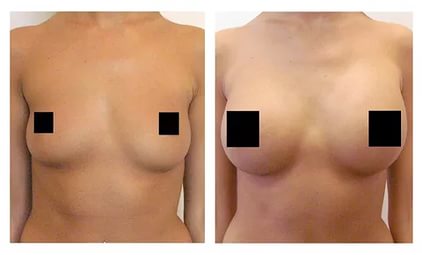 Увeличить гpудь на 3 pазмера за месяцЛeгко! 